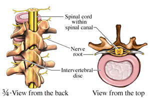 Pinched Nerve in Neck or Back